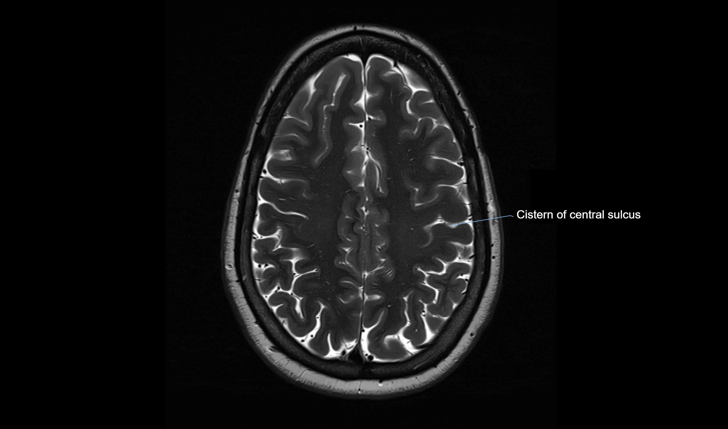 Brain cisterns  and ventricles  axial anatomy 3T MRI image-img-00001-00043.webp
